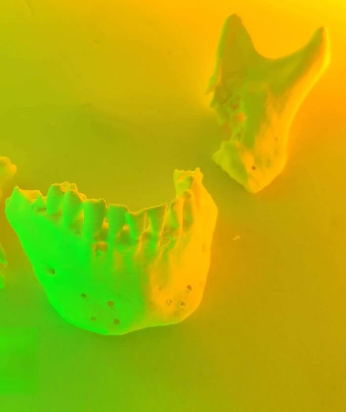 протез 3Д принтер 3Д модель щелепи челюсти пластиковий протез зубів  Реконструкція нижньої щелепи роздроблена щелепа 3D Metal Tech українська медицина