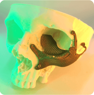 імплант з титану  індивідуалізовані пацієнтоспецифічні імпланти титанові медичні вироби 3д друк україна 3D Metal Tech протез вигтовлення на 3D-принтері 3д печать пластикова модель людського черепа