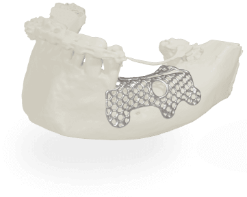 Виготовлення серійних та індивідуальних ендопротезів для хірургії, титанова мембрана для стоматології, Як виглядає титанова мембрана, друк металевих мембран для стоматології