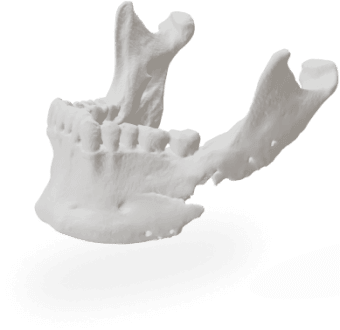 Пластикова анатомічна модель, надрукувати пластик Київ, де надрукувати пластикову анатомічну модель в Києві, Попередня деформація анотомії